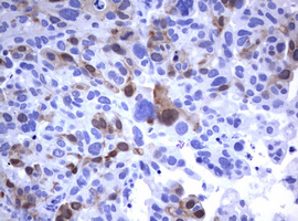 TS / Thymidylate Synthase Antibody - IHC of paraffin-embedded Carcinoma of Human bladder tissue using anti-TYMS mouse monoclonal antibody. (Heat-induced epitope retrieval by 10mM citric buffer, pH6.0, 120°C for 3min).