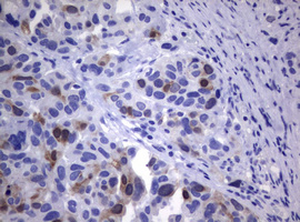 TS / Thymidylate Synthase Antibody - IHC of paraffin-embedded Human lymphoma tissue using anti-TYMS mouse monoclonal antibody. (Heat-induced epitope retrieval by 10mM citric buffer, pH6.0, 120°C for 3min).