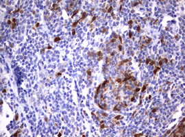 TS / Thymidylate Synthase Antibody - IHC of paraffin-embedded Human lymphoma tissue using anti-TYMS mouse monoclonal antibody.