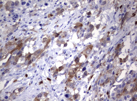 TS / Thymidylate Synthase Antibody - IHC of paraffin-embedded Adenocarcinoma of Human ovary tissue using anti-TYMS mouse monoclonal antibody.
