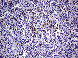 TS / Thymidylate Synthase Antibody - IHC of paraffin-embedded Human lymphoma tissue using anti-TYMS mouse monoclonal antibody. (Heat-induced epitope retrieval by 10mM citric buffer, pH6.0, 120°C for 3min).