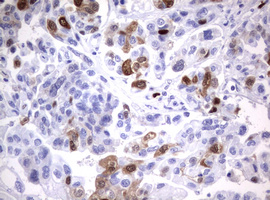 TS / Thymidylate Synthase Antibody - IHC of paraffin-embedded Carcinoma of Human bladder tissue using anti-TYMS mouse monoclonal antibody.