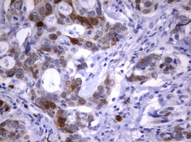 TS / Thymidylate Synthase Antibody - IHC of paraffin-embedded Adenocarcinoma of Human breast tissue using anti-TYMS mouse monoclonal antibody.