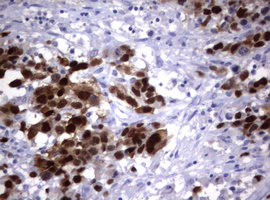 TS / Thymidylate Synthase Antibody - IHC of paraffin-embedded Adenocarcinoma of Human ovary tissue using anti-TYMS mouse monoclonal antibody.