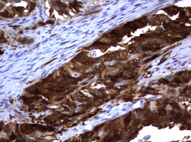 TS / Thymidylate Synthase Antibody - IHC of paraffin-embedded Adenocarcinoma of Human endometrium tissue using anti-TYMS mouse monoclonal antibody.