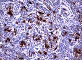 TS / Thymidylate Synthase Antibody - IHC of paraffin-embedded Human lymphoma tissue using anti-TYMS mouse monoclonal antibody.