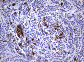 TS / Thymidylate Synthase Antibody - IHC of paraffin-embedded Human lymphoma tissue using anti-TYMS mouse monoclonal antibody.