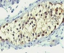 TS / Thymidylate Synthase Antibody - Formalin-fixed, paraffin-embedded human testicular carcinoma stained with anti-Thymidylate Synthase antibody (SPM453).  This image was taken for the unmodified form of this product. Other forms have not been tested.