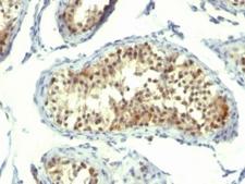 TS / Thymidylate Synthase Antibody - Formalin-fixed, paraffin-embedded human testicular carcinoma stained with Thymidylate Synthase antibody (TMS715).