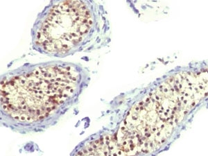 TS / Thymidylate Synthase Antibody - IHC testing of FFPE human testicular carcinoma and Thymidylate Synthase antibody (TYSY9).  This image was taken for the unmodified form of this product. Other forms have not been tested.