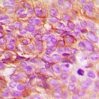 TSAP6 / STEAP3 Antibody - Immunohistochemical analysis of STEAP3 staining in human breast cancer formalin fixed paraffin embedded tissue section. The section was pre-treated using heat mediated antigen retrieval with sodium citrate buffer (pH 6.0). The section was then incubated with the antibody at room temperature and detected using an HRP-conjugated compact polymer system. DAB was used as the chromogen. The section was then counterstained with hematoxylin and mounted with DPX.