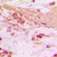 TSC22D1 / TSC22 Antibody - Immunohistochemical analysis of TSC22 staining in human lung cancer formalin fixed paraffin embedded tissue section. The section was pre-treated using heat mediated antigen retrieval with sodium citrate buffer (pH 6.0). The section was then incubated with the antibody at room temperature and detected using an HRP conjugated compact polymer system. DAB was used as the chromogen. The section was then counterstained with hematoxylin and mounted with DPX.