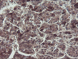TSC22D1 / TSC22 Antibody - IHC of paraffin-embedded Carcinoma of Human liver tissue using anti-TSC22D1 mouse monoclonal antibody.