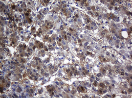 TSC22D1 / TSC22 Antibody - IHC of paraffin-embedded Carcinoma of Human liver tissue using anti-TSC22D1 mouse monoclonal antibody. (Heat-induced epitope retrieval by 10mM citric buffer, pH6.0, 120°C for 3min).