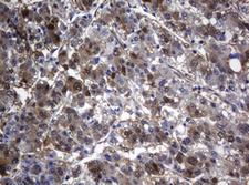 TSC22D1 / TSC22 Antibody - IHC of paraffin-embedded Carcinoma of Human liver tissue using anti-TSC22D1 mouse monoclonal antibody. (Heat-induced epitope retrieval by 10mM citric buffer, pH6.0, 120°C for 3min).