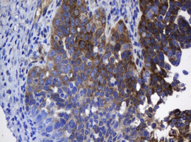 TSC22D1 / TSC22 Antibody - IHC of paraffin-embedded Adenocarcinoma of Human ovary tissue using anti-TSC22D1 mouse monoclonal antibody. (Heat-induced epitope retrieval by 10mM citric buffer, pH6.0, 120°C for 3min).
