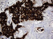 TSC22D1 / TSC22 Antibody - IHC of paraffin-embedded Carcinoma of Human pancreas tissue using anti-TSC22D1 mouse monoclonal antibody.