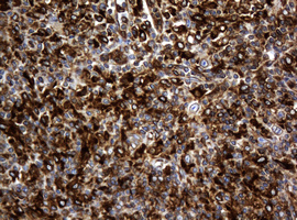 TSC22D1 / TSC22 Antibody - IHC of paraffin-embedded Human lymphoma tissue using anti-TSC22D1 mouse monoclonal antibody.