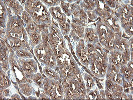 TSC22D1 / TSC22 Antibody - IHC of paraffin-embedded Carcinoma of Human thyroid tissue using anti-TSC22D1 mouse monoclonal antibody.