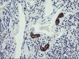 TSC22D1 / TSC22 Antibody - IHC of paraffin-embedded Carcinoma of Human kidney tissue using anti-TSC22D1 mouse monoclonal antibody.