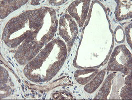 TSC22D1 / TSC22 Antibody - IHC of paraffin-embedded Carcinoma of Human prostate tissue using anti-TSC22D1 mouse monoclonal antibody.