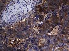TSC22D1 / TSC22 Antibody - IHC of paraffin-embedded Adenocarcinoma of Human colon tissue using anti-TSC22D1 mouse monoclonal antibody.