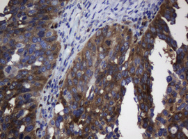 TSC22D1 / TSC22 Antibody - IHC of paraffin-embedded Adenocarcinoma of Human ovary tissue using anti-TSC22D1 mouse monoclonal antibody.