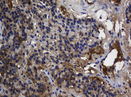 TSC22D1 / TSC22 Antibody - IHC of paraffin-embedded Carcinoma of Human pancreas tissue using anti-TSC22D1 mouse monoclonal antibody.