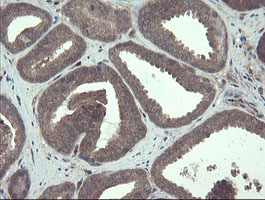 TSC22D1 / TSC22 Antibody - IHC of paraffin-embedded Carcinoma of Human prostate tissue using anti-TSC22D1 mouse monoclonal antibody.