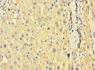 TSC22D3 / GILZ Antibody - Immunohistochemistry of paraffin-embedded human liver cancer using TSC22D3 Antibody at dilution of 1:100