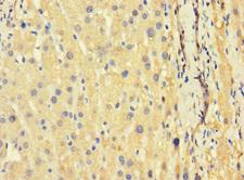 TSC22D3 / GILZ Antibody - Immunohistochemistry of paraffin-embedded human liver cancer using TSC22D3 Antibody at dilution of 1:100