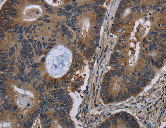 TSC22D3 / GILZ Antibody - Immunohistochemistry of paraffin-embedded Human liver cancer using TSC22D3 Polyclonal Antibody at dilution of 1:40.