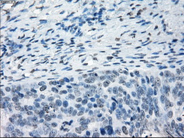 TSC501 / NAT8 Antibody - IHC of paraffin-embedded Adenocarcinoma of ovary tissue using anti-NAT8 mouse monoclonal antibody. (Dilution 1:50).