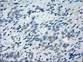 TSC501 / NAT8 Antibody - IHC of paraffin-embedded Carcinoma of bladder tissue using anti-NAT8 mouse monoclonal antibody. (Dilution 1:50).