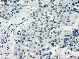 TSC501 / NAT8 Antibody - IHC of paraffin-embedded Adenocarcinoma of breast tissue using anti-NAT8 mouse monoclonal antibody. (Dilution 1:50).