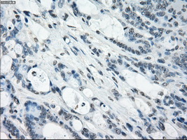 TSC501 / NAT8 Antibody - IHC of paraffin-embedded Adenocarcinoma of colon tissue using anti-NAT8 mouse monoclonal antibody. (Dilution 1:50).