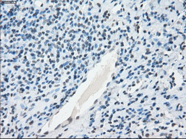 TSC501 / NAT8 Antibody - IHC of paraffin-embedded Carcinoma of thyroid tissue using anti-NAT8 mouse monoclonal antibody. (Dilution 1:50).