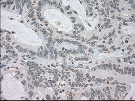 TSC501 / NAT8 Antibody - IHC of paraffin-embedded Adenocarcinoma of colon tissue using anti-NAT8 mouse monoclonal antibody. (Dilution 1:50).
