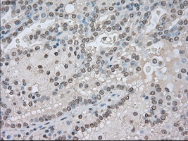 TSC501 / NAT8 Antibody - IHC of paraffin-embedded Carcinoma of kidney tissue using anti-NAT8 mouse monoclonal antibody. (Dilution 1:50).