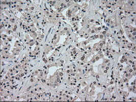 TSC501 / NAT8 Antibody - IHC of paraffin-embedded Carcinoma of prostate tissue using anti-NAT8 mouse monoclonal antibody. (Dilution 1:50).