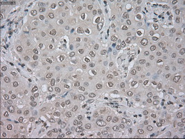 TSC501 / NAT8 Antibody - IHC of paraffin-embedded Adenocarcinoma of breast tissue using anti-NAT8 mouse monoclonal antibody. (Dilution 1:50).
