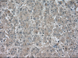 TSC501 / NAT8 Antibody - IHC of paraffin-embedded Carcinoma of liver tissue using anti-NAT8 mouse monoclonal antibody. (Dilution 1:50).