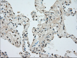 TSC501 / NAT8 Antibody - IHC of paraffin-embedded Carcinoma of lung tissue using anti-NAT8 mouse monoclonal antibody. (Dilution 1:50).