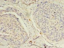 TSC501 / NAT8 Antibody - Immunohistochemistry of paraffin-embedded human cervical cancer using antibody at dilution of 1:100.