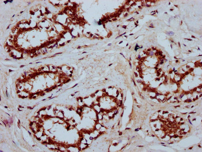 TSEN15 Antibody - Immunohistochemistry Dilution at 1:400 and staining in paraffin-embedded human breast cancer performed on a Leica BondTM system. After dewaxing and hydration, antigen retrieval was mediated by high pressure in a citrate buffer (pH 6.0). Section was blocked with 10% normal Goat serum 30min at RT. Then primary antibody (1% BSA) was incubated at 4°C overnight. The primary is detected by a biotinylated Secondary antibody and visualized using an HRP conjugated SP system.