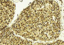 TSEN2 Antibody - 1:100 staining human breast carcinoma tissue by IHC-P. The sample was formaldehyde fixed and a heat mediated antigen retrieval step in citrate buffer was performed. The sample was then blocked and incubated with the antibody for 1.5 hours at 22°C. An HRP conjugated goat anti-rabbit antibody was used as the secondary.