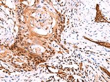 TSEN2 Antibody - Immunohistochemistry of paraffin-embedded Human esophagus cancer tissue  using TSEN2 Polyclonal Antibody at dilution of 1:60(×200)