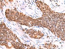 TSEN2 Antibody - Immunohistochemistry of paraffin-embedded Human esophagus cancer tissue  using TSEN2 Polyclonal Antibody at dilution of 1:80(×200)