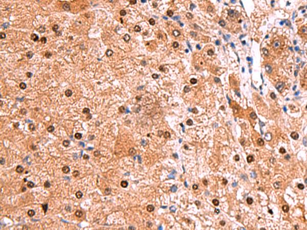 TSEN2 Antibody - Immunohistochemistry of paraffin-embedded Human liver cancer tissue  using TSEN2 Polyclonal Antibody at dilution of 1:80(×200)