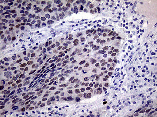 TSEN34 Antibody - Immunohistochemical staining of paraffin-embedded Carcinoma of Human lung tissue using anti-TSEN34 mouse monoclonal antibody. (Heat-induced epitope retrieval by 1mM EDTA in 10mM Tris buffer. (pH8.5) at 120°C for 3 min. (1:150)